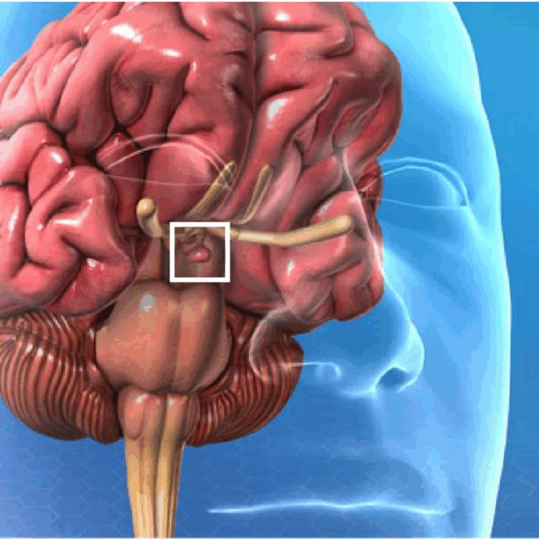 Image skull base tumor w alpha