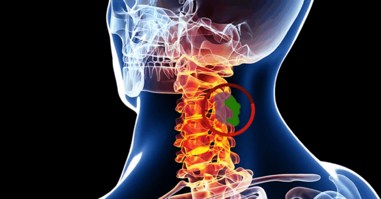Image spine tumor w alpha