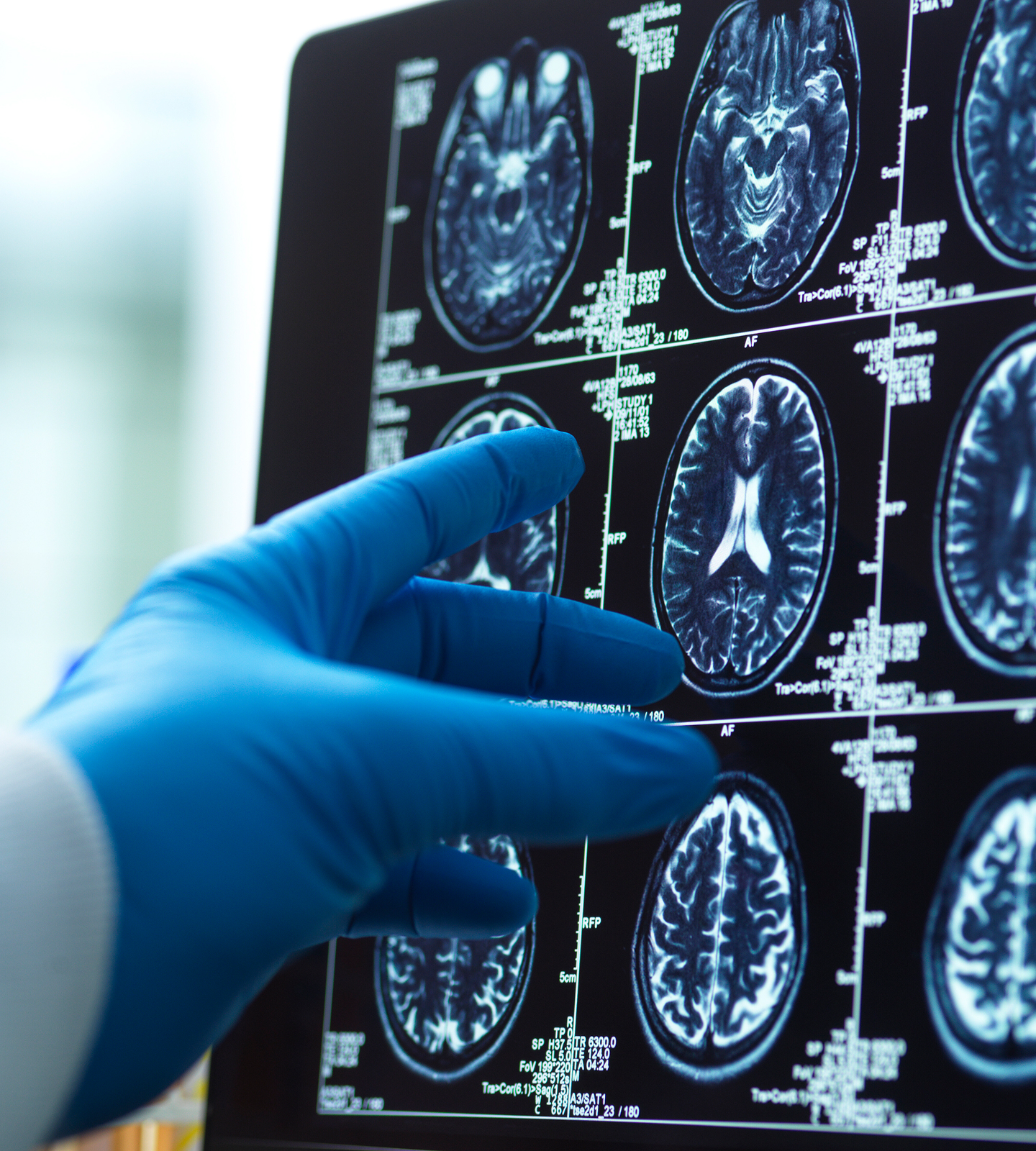 Precision Conditions BrainAneurysm Hero Desktop