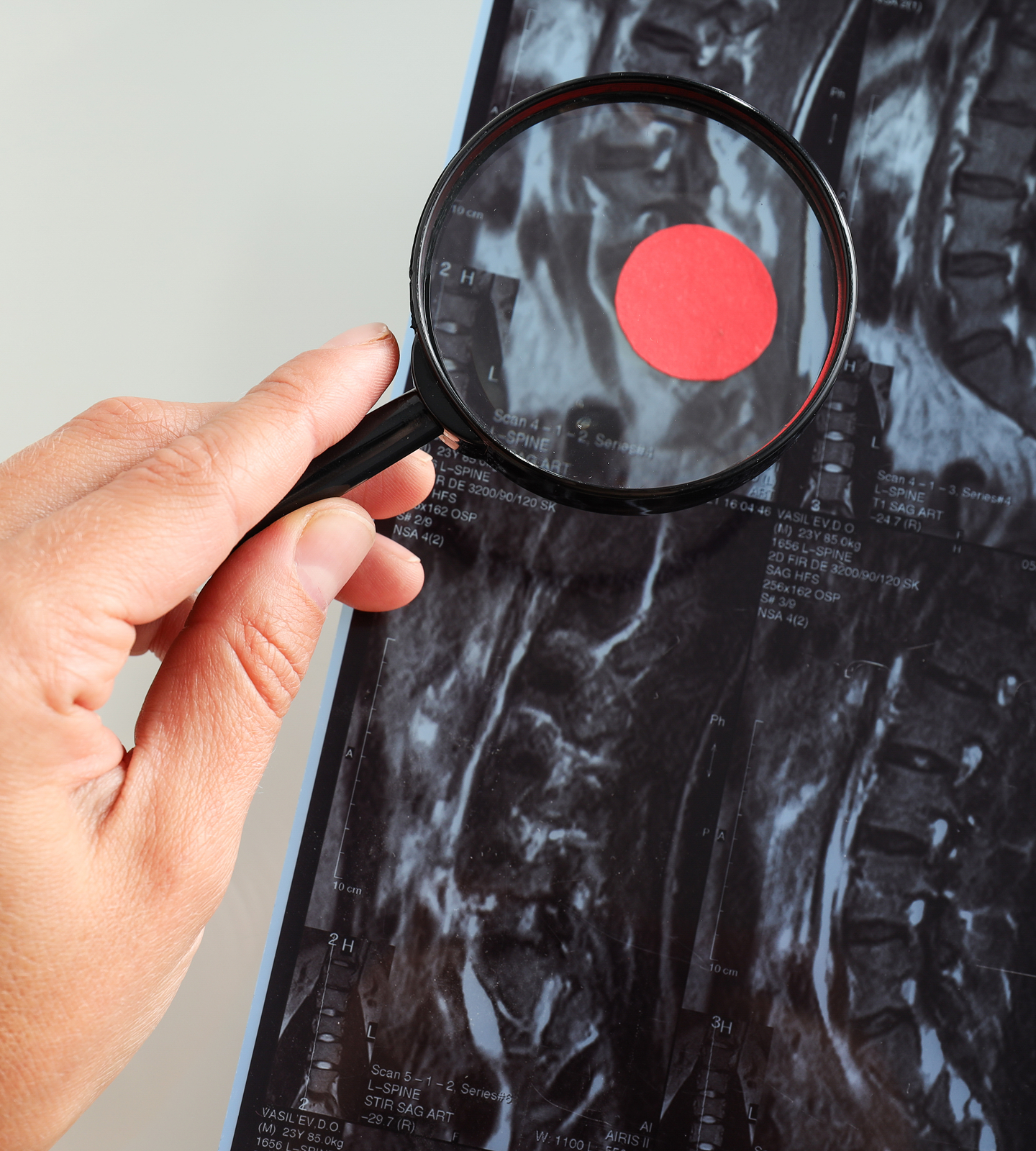 Precision Conditions SpineTumours Hero Desktop