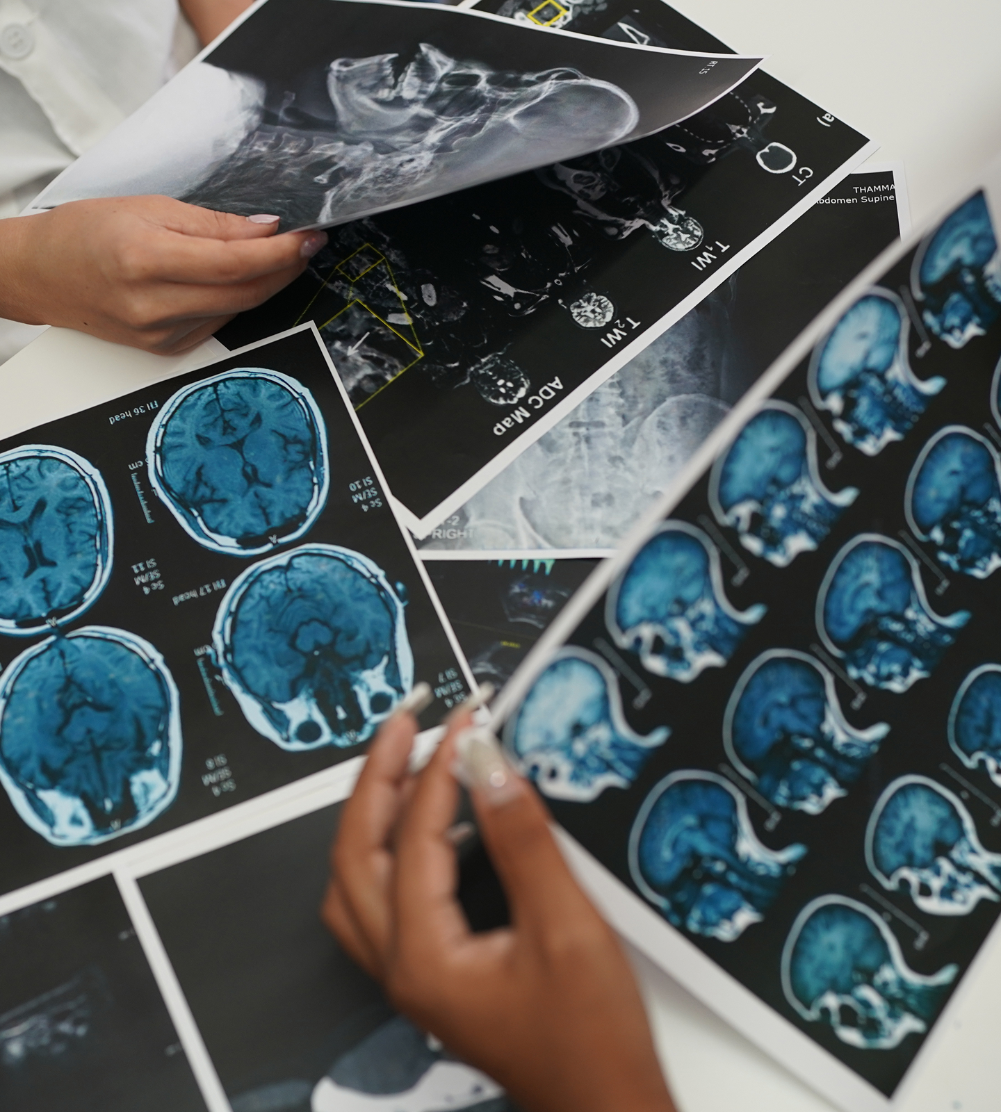 Precision Treatment Brain Aneurysm Hero Desktop